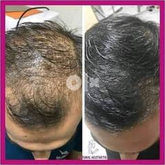 Are u facing issue for hairloss??
Baldness?
Weak hair? 0