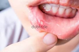 mouth blisters medicine
